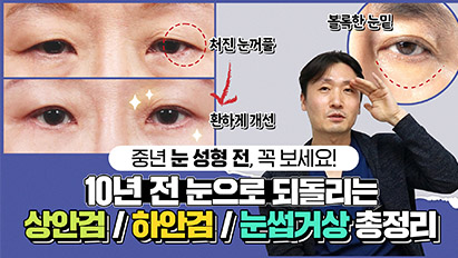 중년눈성형 전, 필수로 정주행해야하는 영상ㅣ\'이것\'알아야 부릅뜬 옴팡눈 안 됩니다