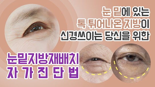 눈밑지방재배치 문혜영대표원장이 싹-다말해줌!!!!!