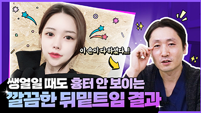 뒤밑트임 하고 싶은사람? 체크리스트 싹!다! 알려드림ㅣ뒤밑트임 후 눈웃음이 안 된다?ㅣ무쌍도 트임만으로 연예인 눈 가능..?