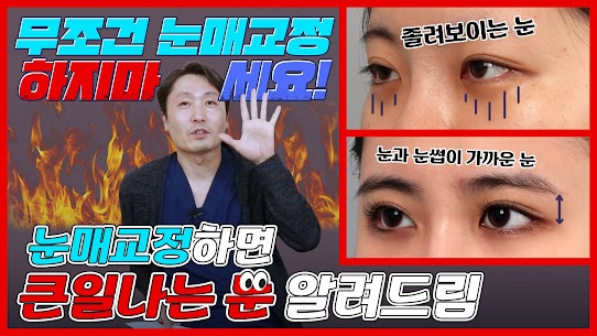 눈매교정의 정확한 의미는?! 눈매교정의 중요성