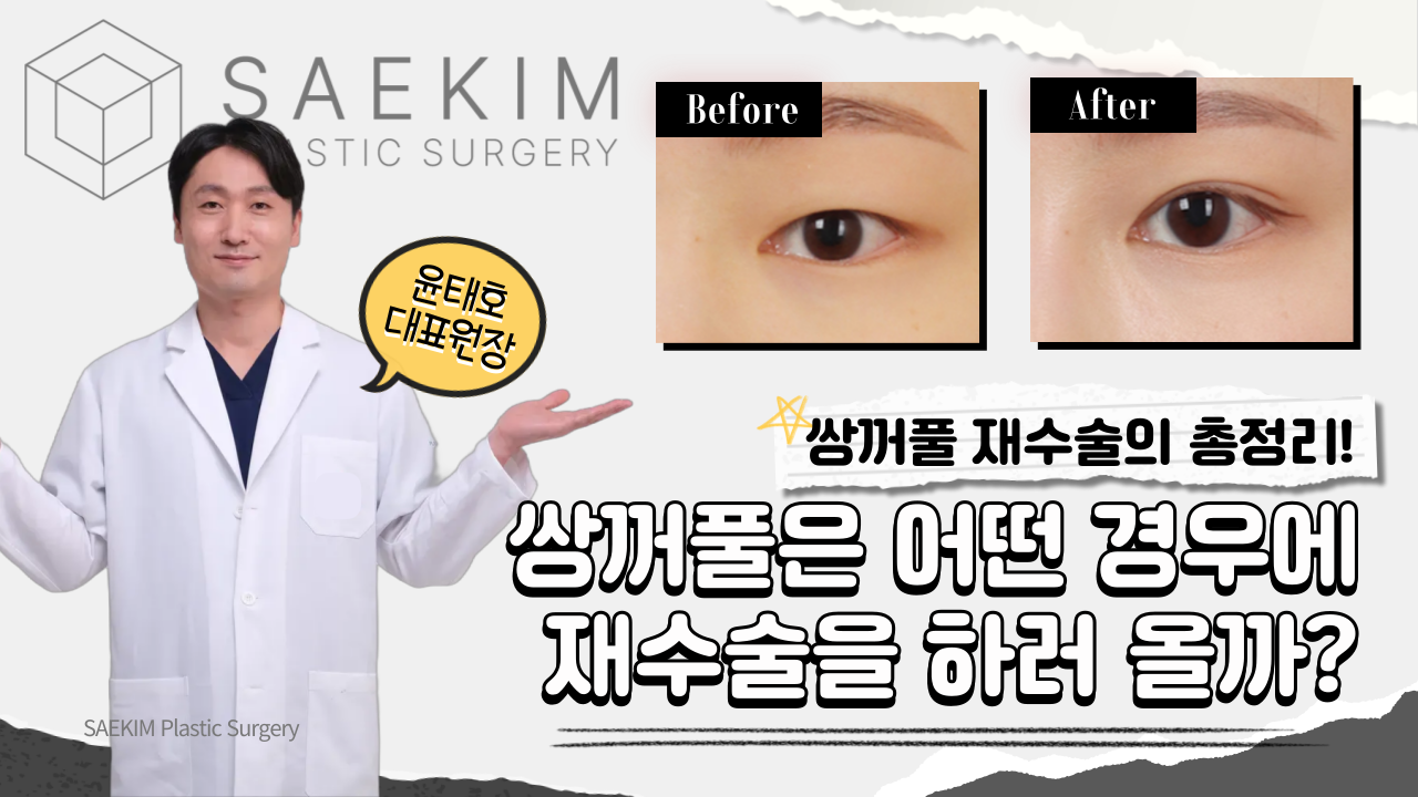 쌍꺼풀 재수술은 보통 어떤 경우에 하나요??｜쌍꺼풀재수술(1)