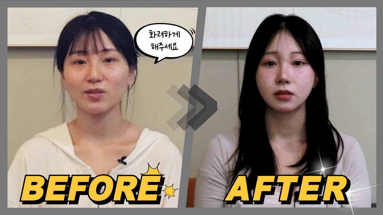 화려함을 원하셨던 성형 후기입니다!!!! 새김성형외과의 재방문의 결과 바로 보시죠! 윤곽, 눈, 코, 심부볼 제거