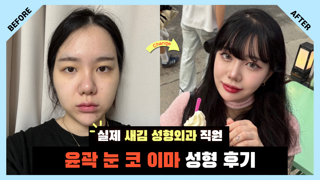 윤곽·눈·코에 이어… 이마까지 완성! 성형외과 직원의 리얼 성형 마지막 이야기 / 윤곽 + 눈 + 코 + 이마